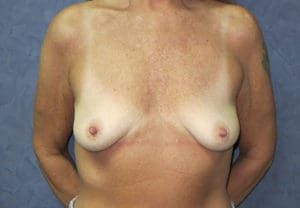 Breast Augmentation Before and After Pictures West Palm Beach, FL