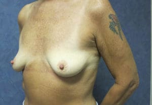 Breast Augmentation Before and After Pictures West Palm Beach, FL