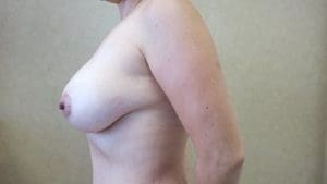 Breast Augmentation Before and After Pictures West Palm Beach, FL