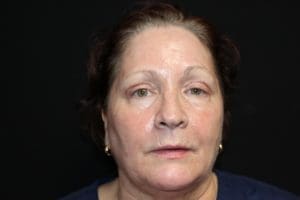 Blepharoplasty Before and After Pictures West Palm Beach, FL