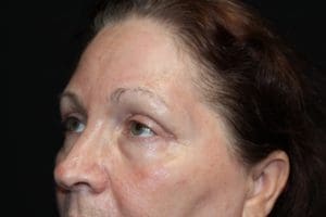 Laser Erbium Before and After Pictures West Palm Beach, FL