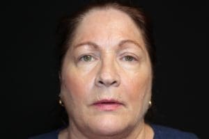 Laser Erbium Before and After Pictures West Palm Beach, FL