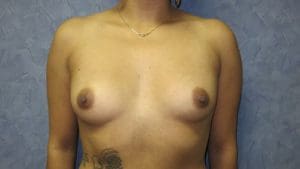 Breast Augmentation Before and After Pictures West Palm Beach, FL