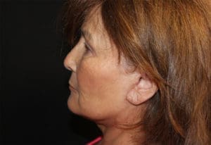 Facelift Before and After Pictures West Palm Beach, FL