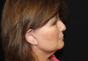 Facelift Before and After Pictures West Palm Beach, FL