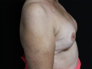 Nipple Reconstruction Before and After Pictures West Palm Beach, FL