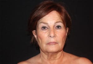 Facelift Before and After Pictures West Palm Beach, FL