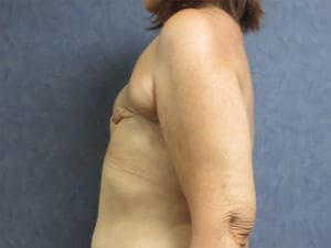 Nipple Reconstruction Before and After Pictures West Palm Beach, FL