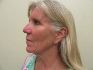 Facelift Before and After Pictures West Palm Beach, FL