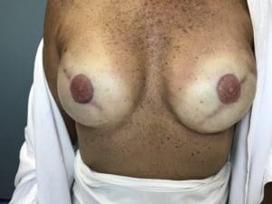 3D Nipple Tattooing Before and After Pictures West Palm Beach, FL