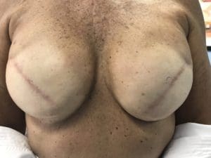 3D Nipple Tattooing Before and After Pictures West Palm Beach, FL