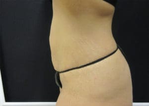 Abdominoplasty Before and After Pictures West Palm Beach, FL