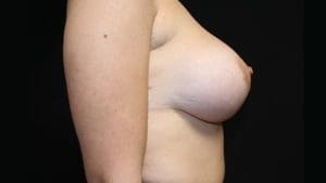 Breast Augmentation Before and After Pictures West Palm Beach, FL