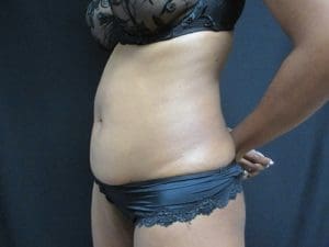 Liposuction Before and After Pictures West Palm Beach, FL