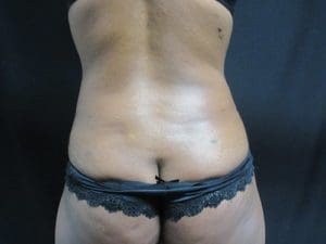 Liposuction Before and After Pictures West Palm Beach, FL