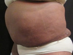 Panniculectomy Before and After Pictures West Palm Beach, FL