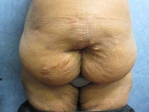 Panniculectomy Before and After Pictures West Palm Beach, FL