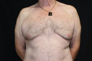 Gynecomastia Before and After Pictures West Palm Beach, FL