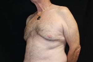 Gynecomastia Before and After Pictures West Palm Beach, FL