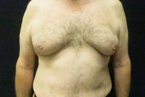 Gynecomastia Before and After Pictures West Palm Beach, FL