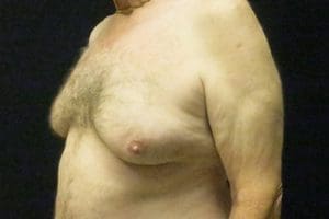 Gynecomastia Before and After Pictures West Palm Beach, FL