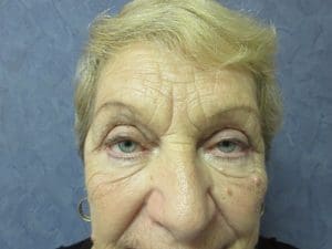Upper Blepharoplasty Before and After Pictures West Palm Beach, FL