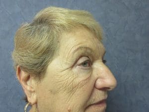 Upper Blepharoplasty Before and After Pictures West Palm Beach, FL
