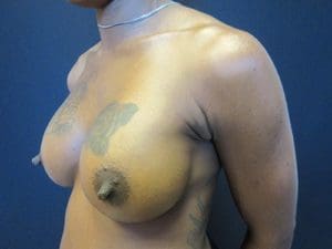 Breast Augmentation Before and After Pictures West Palm Beach, FL