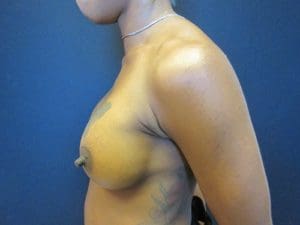 Breast Augmentation Before and After Pictures West Palm Beach, FL