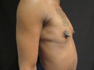 Breast Augmentation Before and After Pictures West Palm Beach, FL