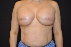 3D Nipple Tattooing Before and After Pictures West Palm Beach, FL