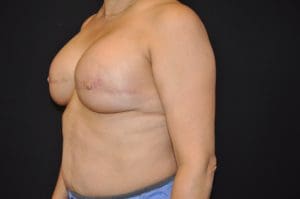 3D Nipple Tattooing Before and After Pictures West Palm Beach, FL