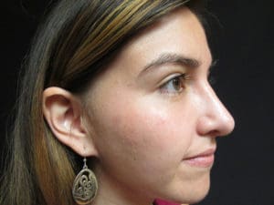 Rhinoplasty Before and After Pictures West Palm Beach, FL