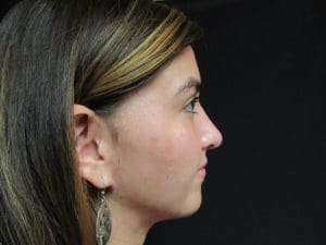 Rhinoplasty Before and After Pictures West Palm Beach, FL