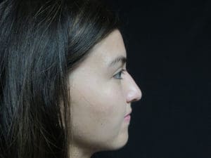 Rhinoplasty Before and After Pictures West Palm Beach, FL