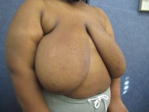 Breast Reduction Before and After Pictures West Palm Beach, FL