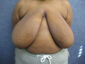 Breast Reduction Before and After Pictures West Palm Beach, FL