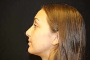 Rhinoplasty Before and After Pictures West Palm Beach, FL