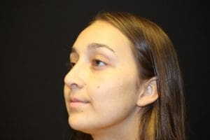 Rhinoplasty Before and After Pictures West Palm Beach, FL