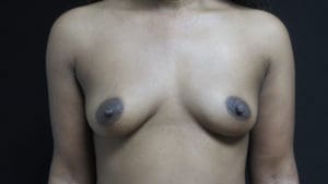 Breast Augmentation Before and After Pictures in West Palm Beach, FL