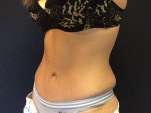 Abdominoplasty Before and After Pictures in West Palm Beach, FL