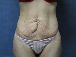 Abdominoplasty Before and After Pictures in West Palm Beach, FL