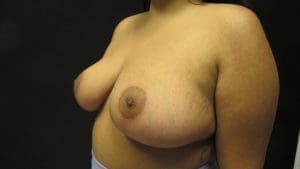 Breast Reduction Before and After Pictures in West Palm Beach, FL