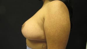 Breast Reduction Before and After Pictures in West Palm Beach, FL