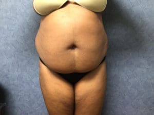 Liposuction Before and After Pictures in West Palm Beach, FL