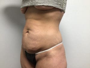 Abdominoplasty Before and After Pictures in West Palm Beach, FL