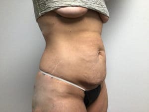 Abdominoplasty Before and After Pictures in West Palm Beach, FL