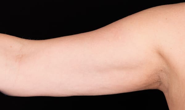 CoolSculpting® in West Palm Beach and Jupiter, FL