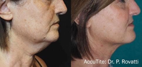 AccuTite