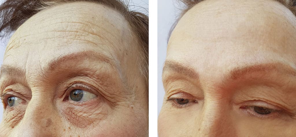 Brow Lift in West Palm Beach and Jupiter, FL